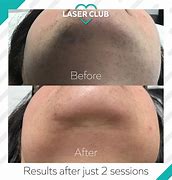 Chin-Laser Hair Removal