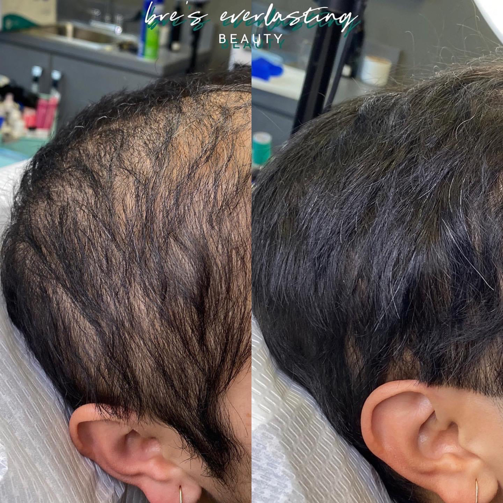 Hair Restoration Full 10 Weeks