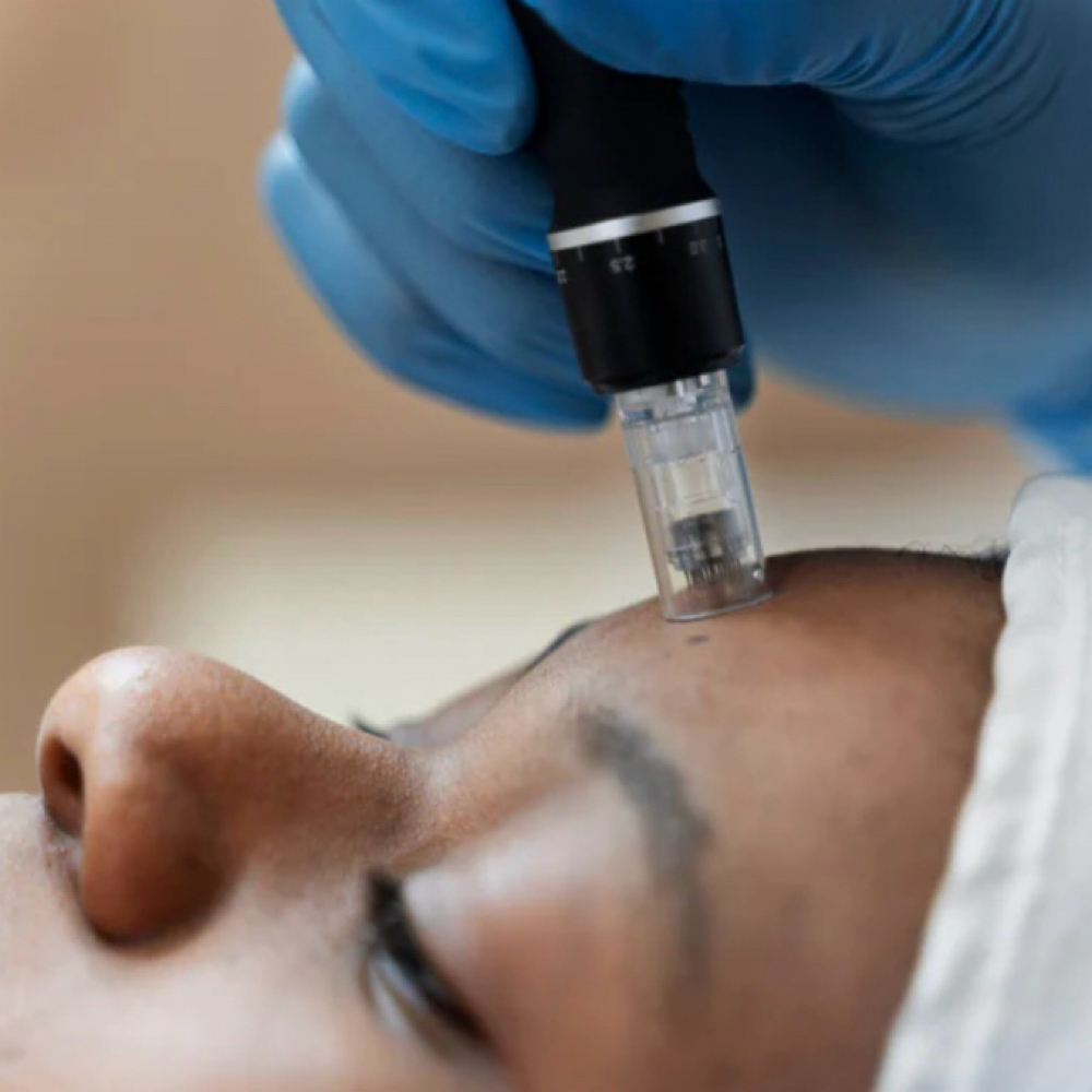 Collogen induction Facial Treatment at Blink and Bare Beauty Aesthetics in Daytona Beach, FL