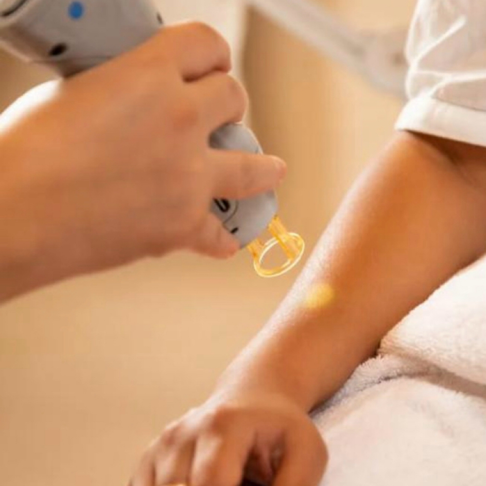 Full arms laser- one session at SLS Laser Medspa in Ontario, CA