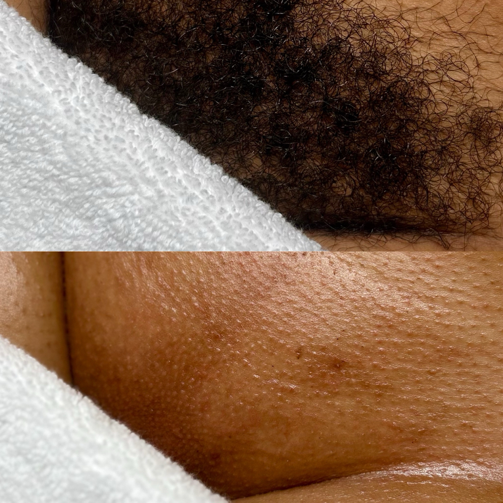 Full Brazilian Wax