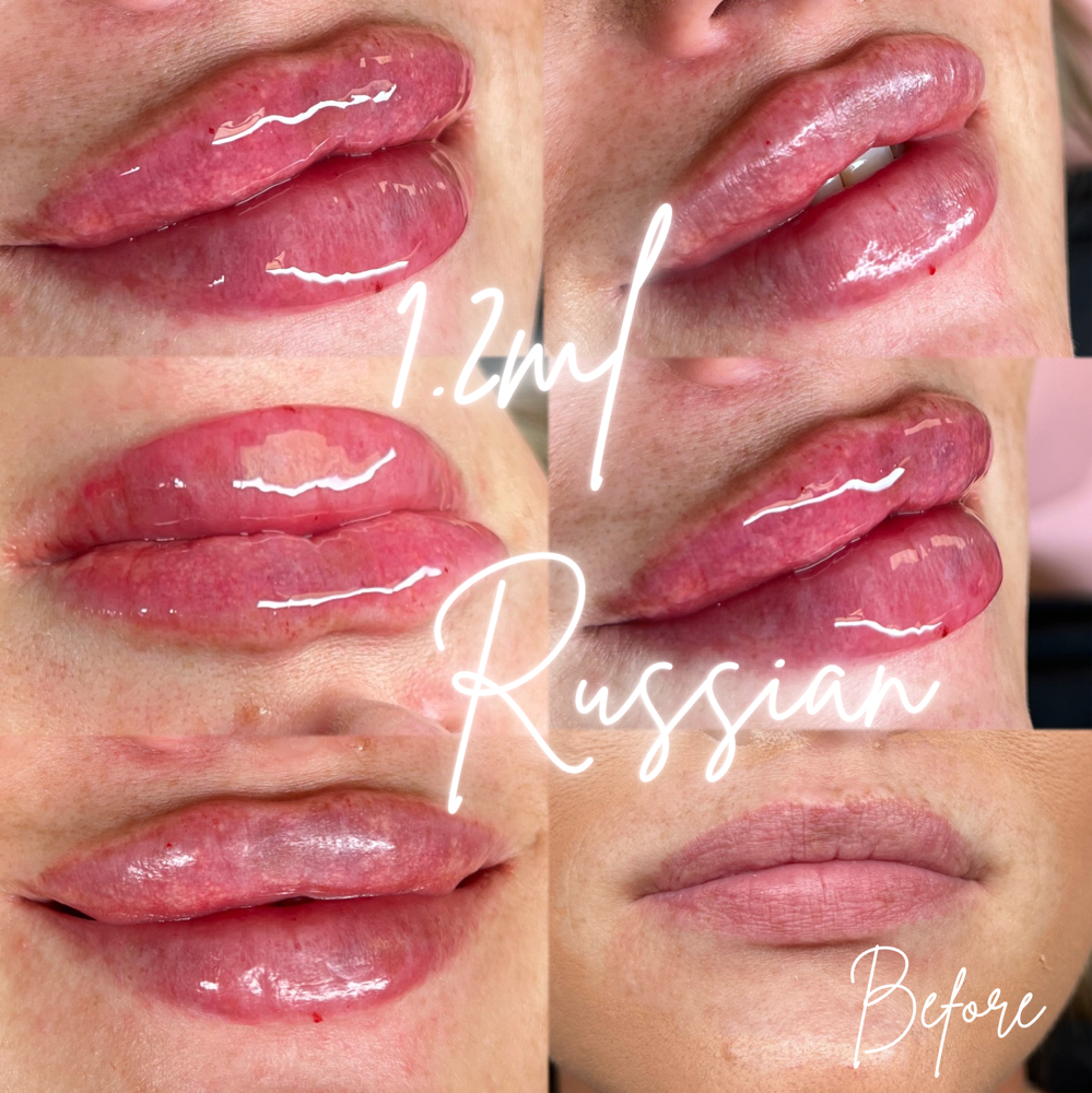 1.2ML Russian Technique💋💉 at BeautyHolic Aesthetics LLC in Lubbock, TX