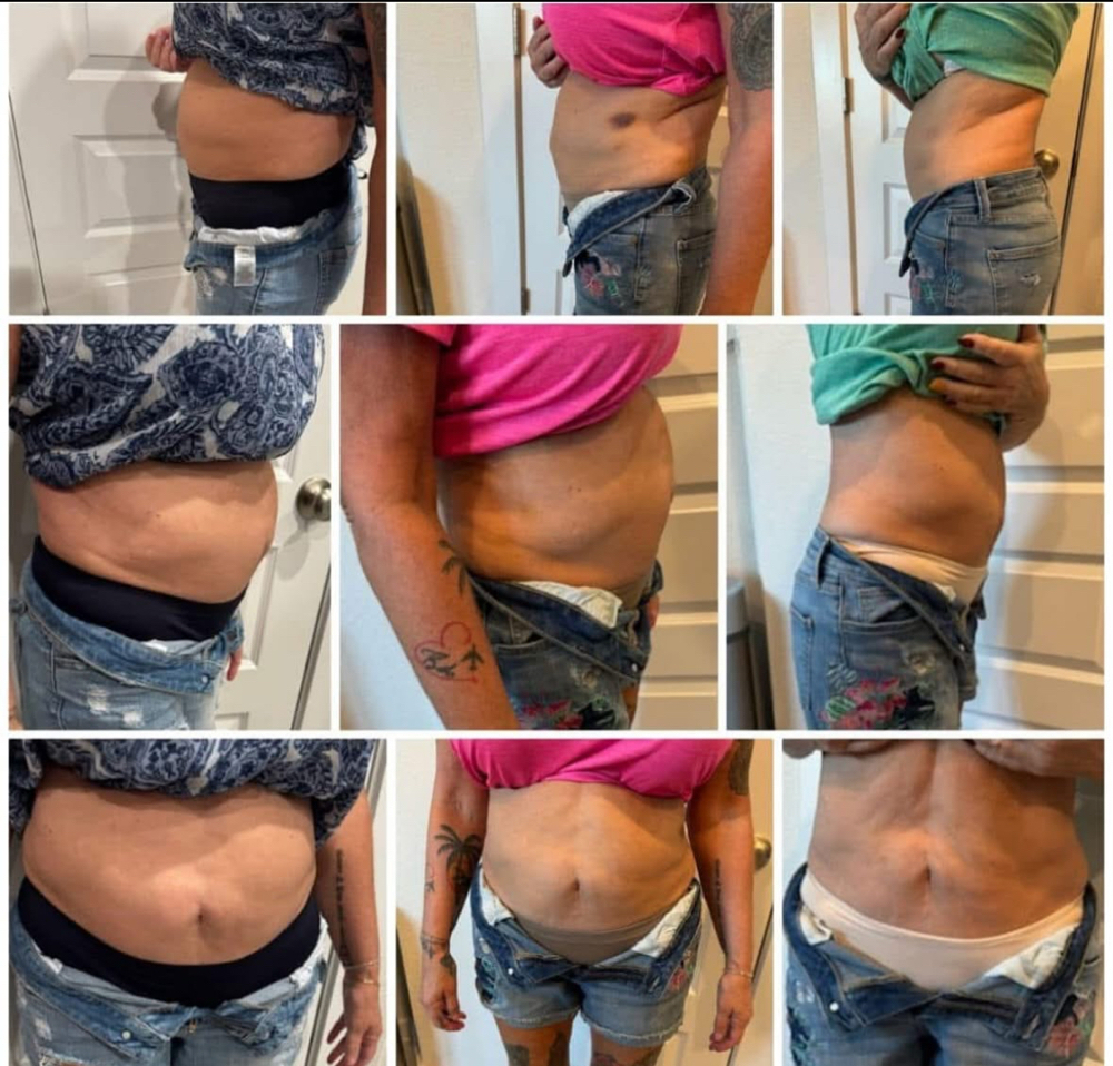FAT/LIPO DISSOLVER - ABDOMEN AREA