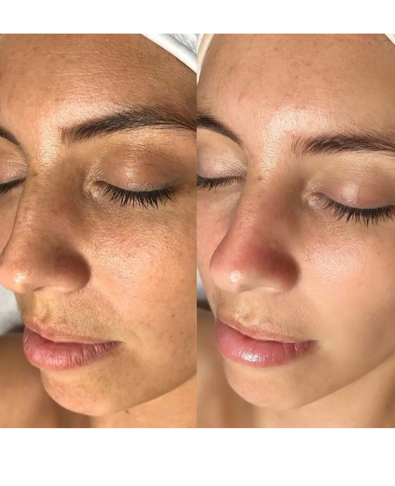 Oxygen Facial