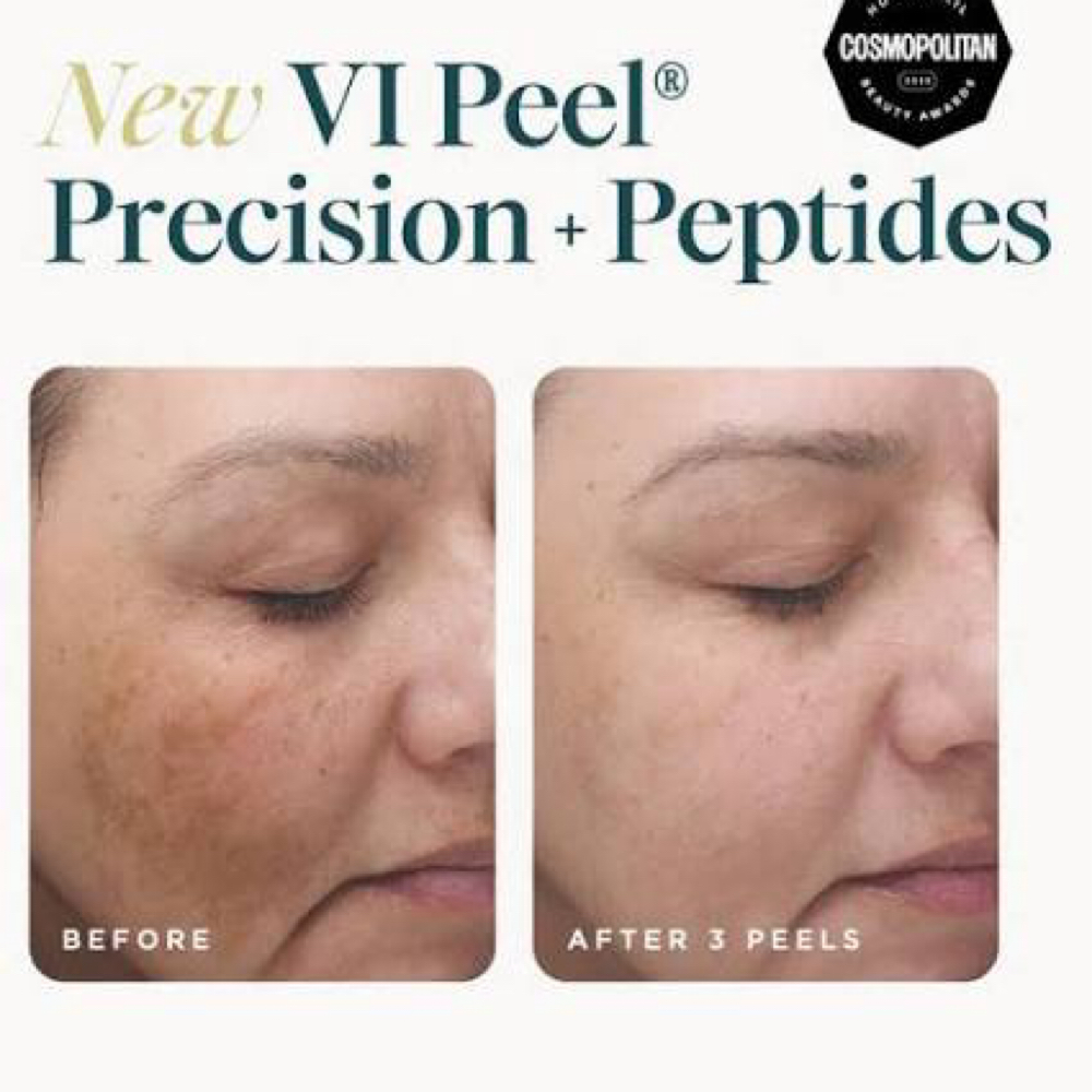 VI Peel Advanced Treatment+ peptide at Skin & Syringe Aesthetics in Rockwall, TX