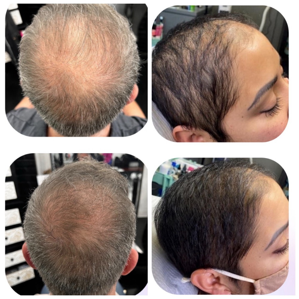 MICROCHANNELING Hair treatment at Lumeva Aesthetic  L.L.C in Maryland, MD
