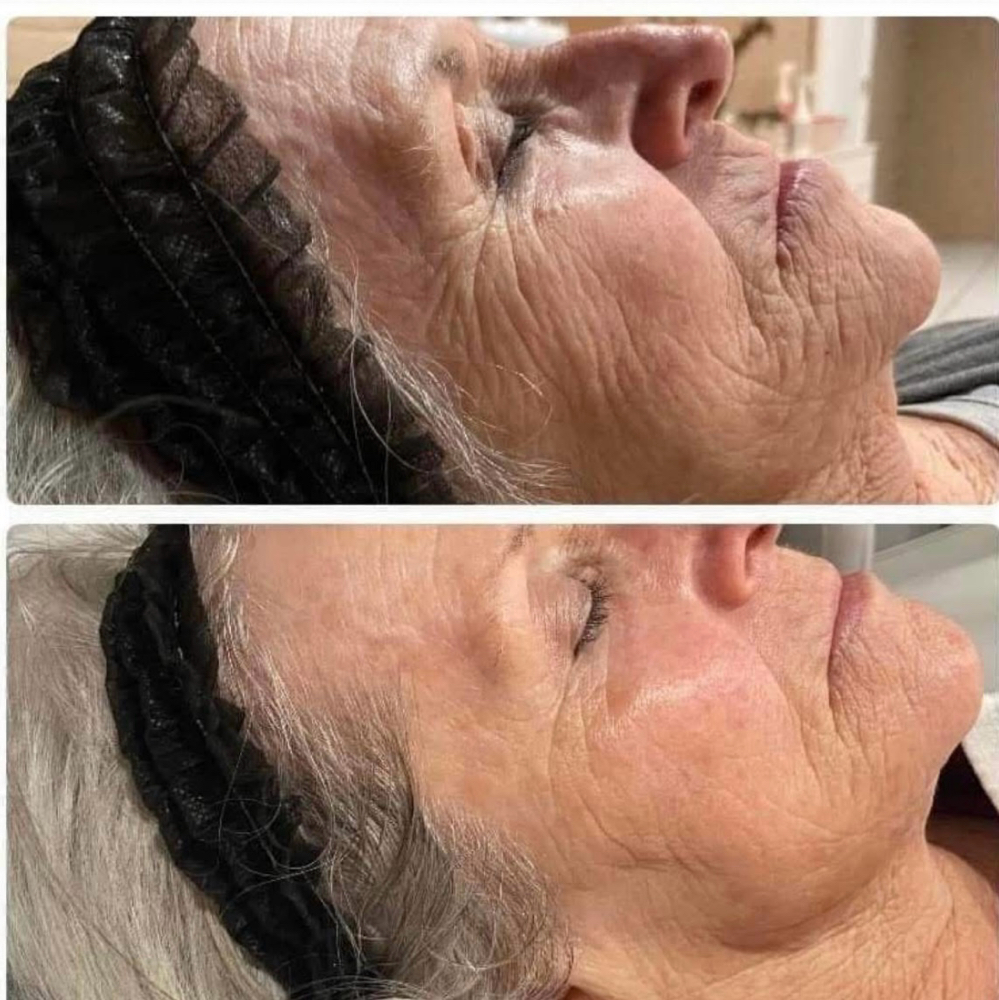 Procell Series Of 4 Treatments