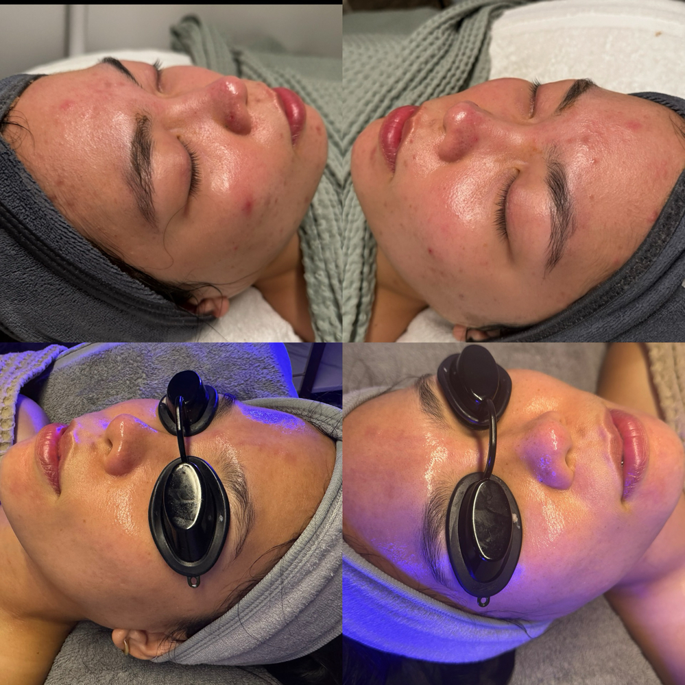 Acne Consult + Facial