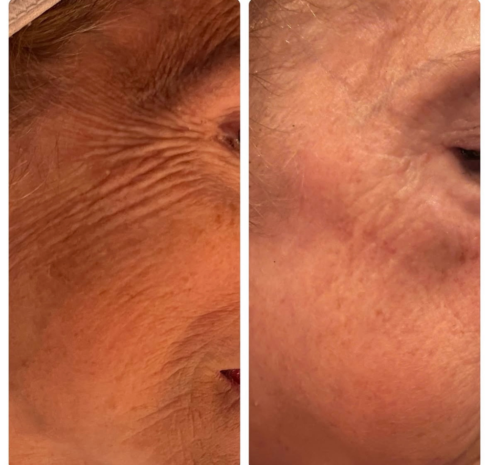 BkF 4-1 Face Package