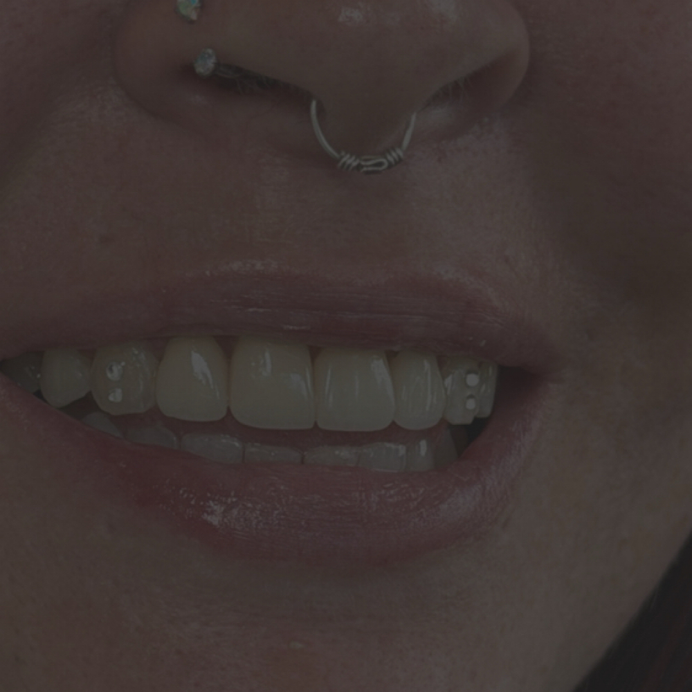 Tooth Gems at Honest Smile Studio | Teeth Whitening & Tooth Gems in South Jordan, UT