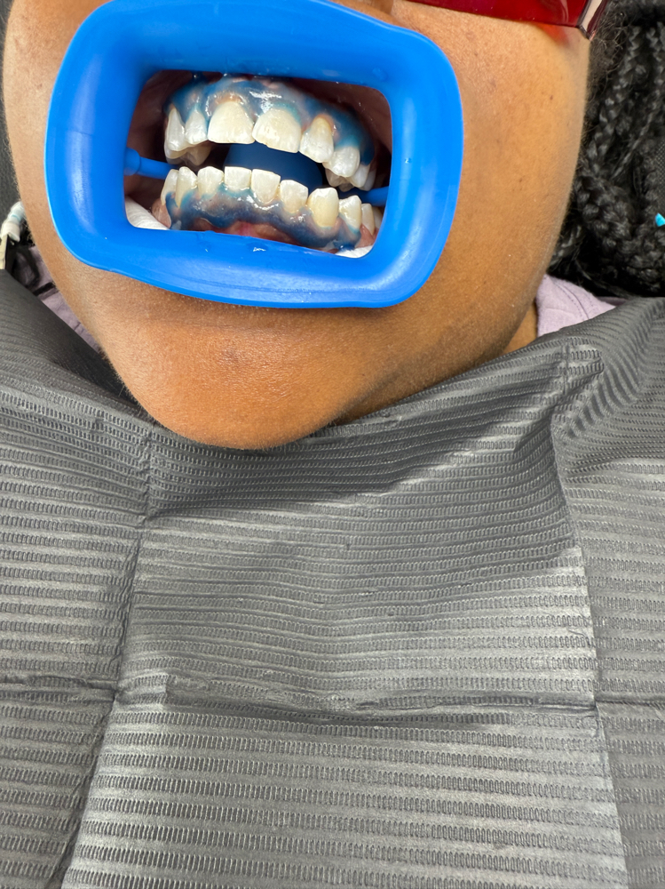 Teeth Whitening