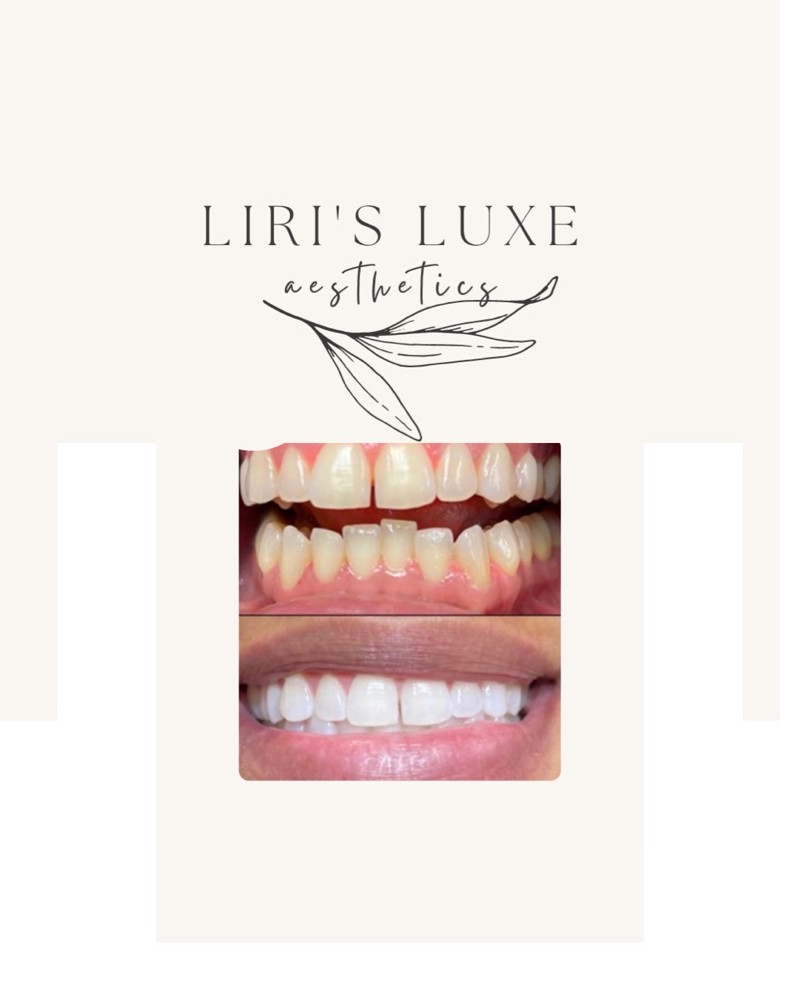 90 Min. Teeth Whitening