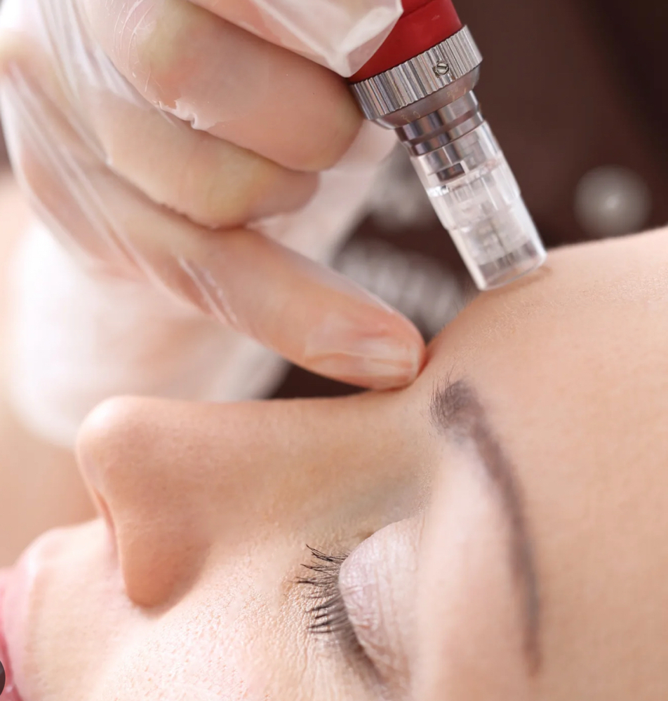 Microneedling