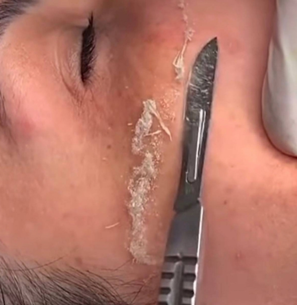 Dermaplaning