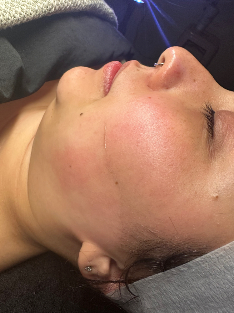 Dermaplane Treatment