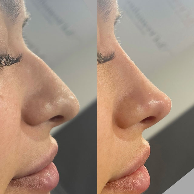Non-surgical Rhinoplasty