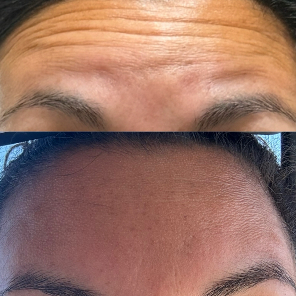 Forehead lines at Modern Aesthetics LLC in Corpus Christi, TX