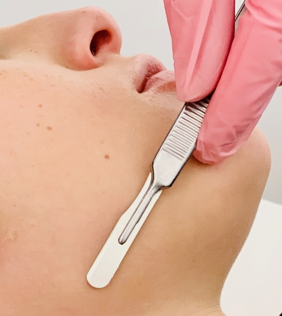 Dermaplane Facial