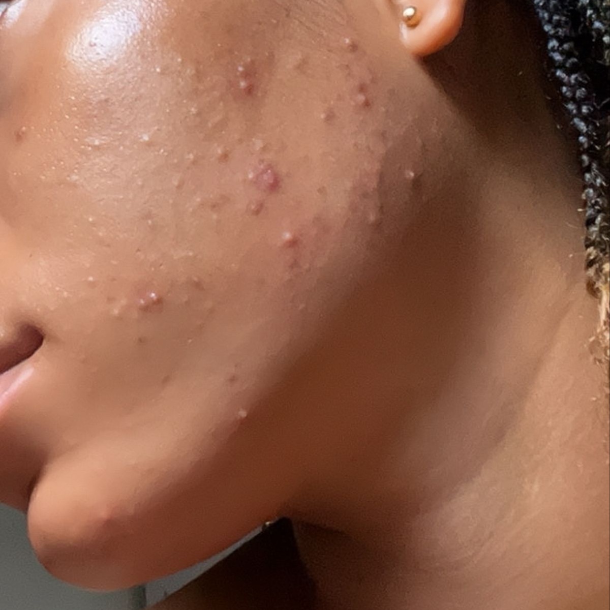 Acne Bootcamp: Signature Facial at Kaiyani Esthetics in Nashville, TN