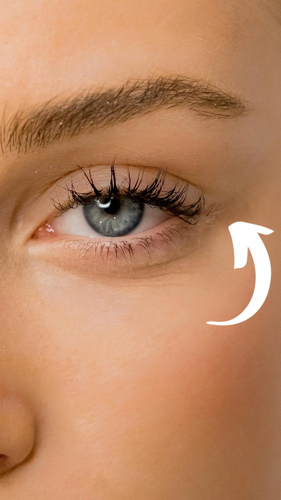 Crow’s Feet Botox
