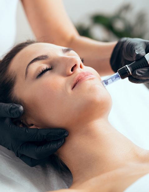 Microneedling at CryoChill Spa in Fort Collins, CO