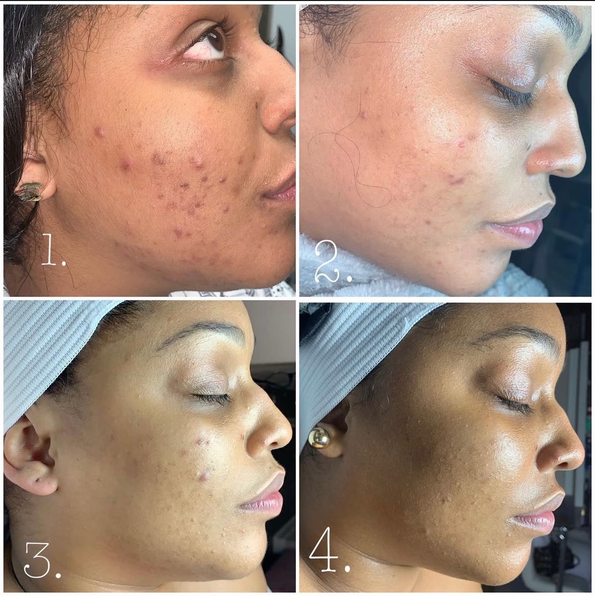 Micro-needling