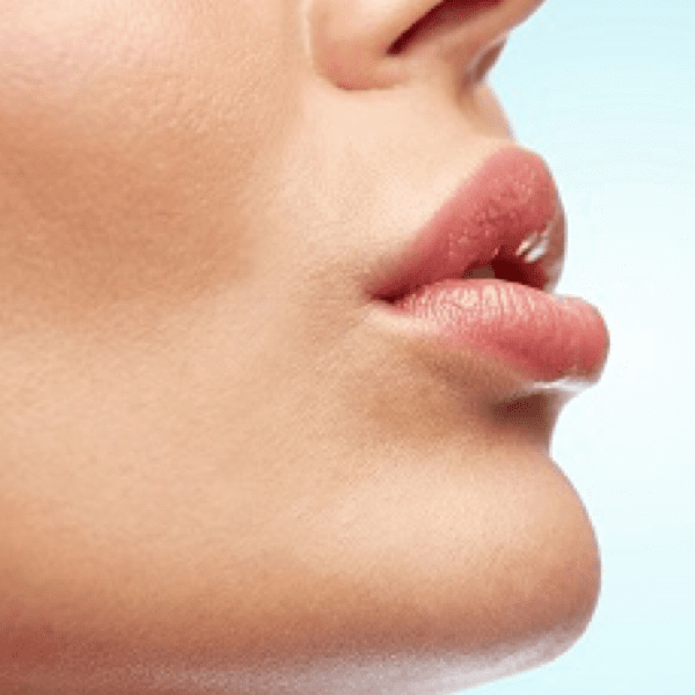 Lip Flip (Botox) at Kelly Sorza Beauty Esthetic in San Jose, CA