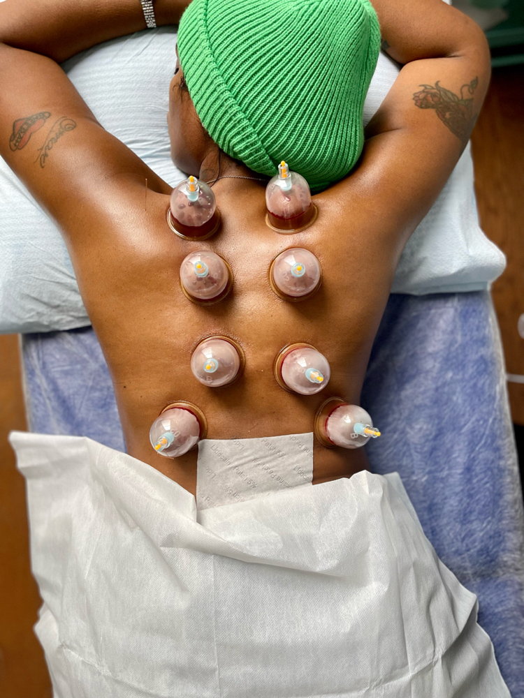 Cupping Therapy