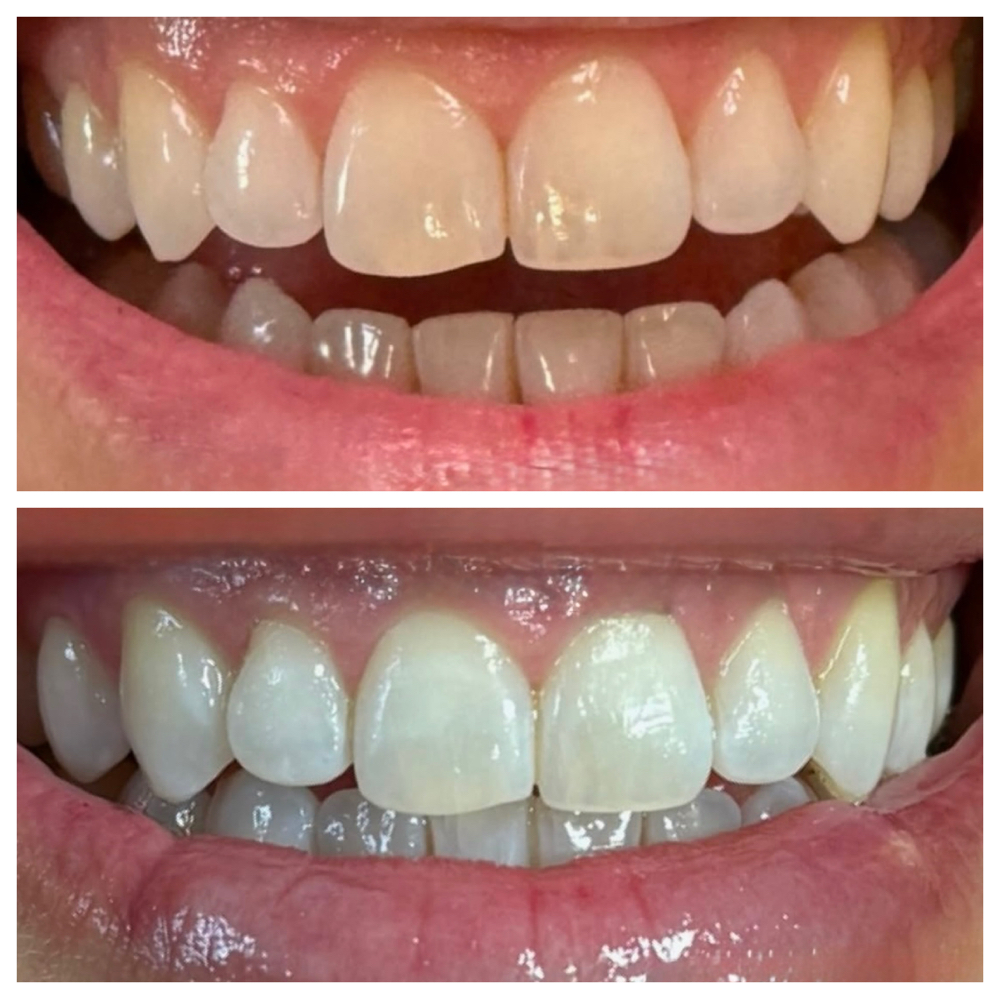 Teeth Whitening