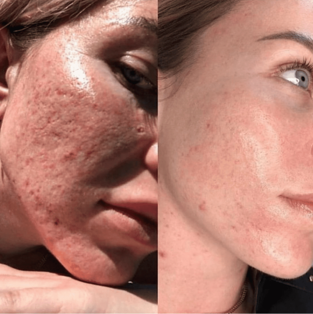 Acne Scar / Intensive Resurfacing at Flawless Spa & Beauty in Fort Worth, TX