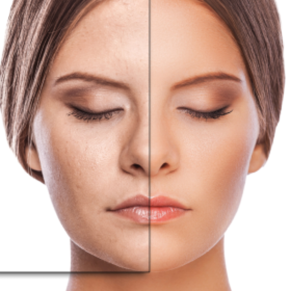 CO2+fractional Laser at Holistic Beauty in View On Website, NY