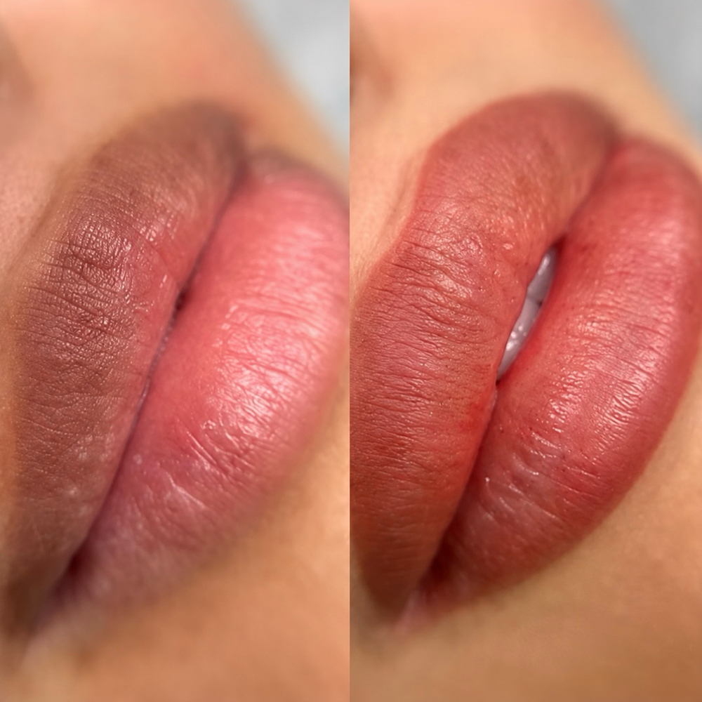 Lip Neutralization at Posy Aesthetics in Dallas, TX