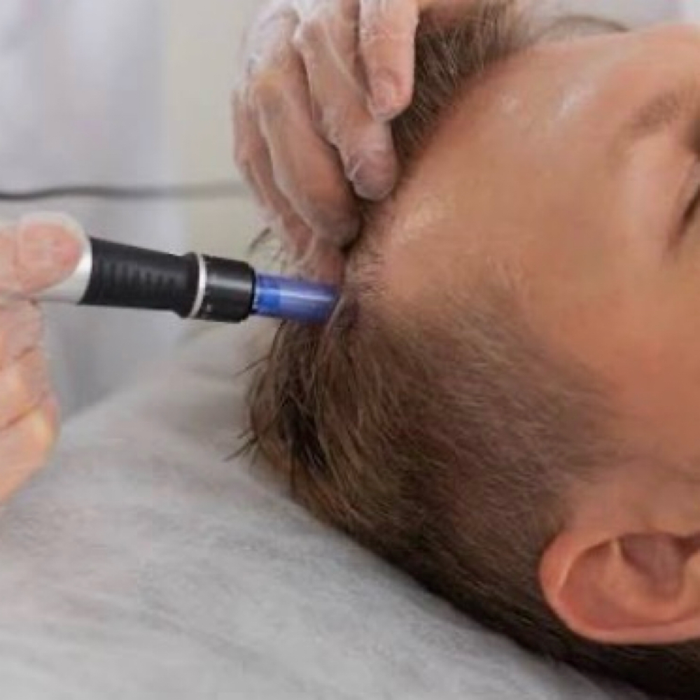 Scalp Microneedling at Antidote Mobile Studio