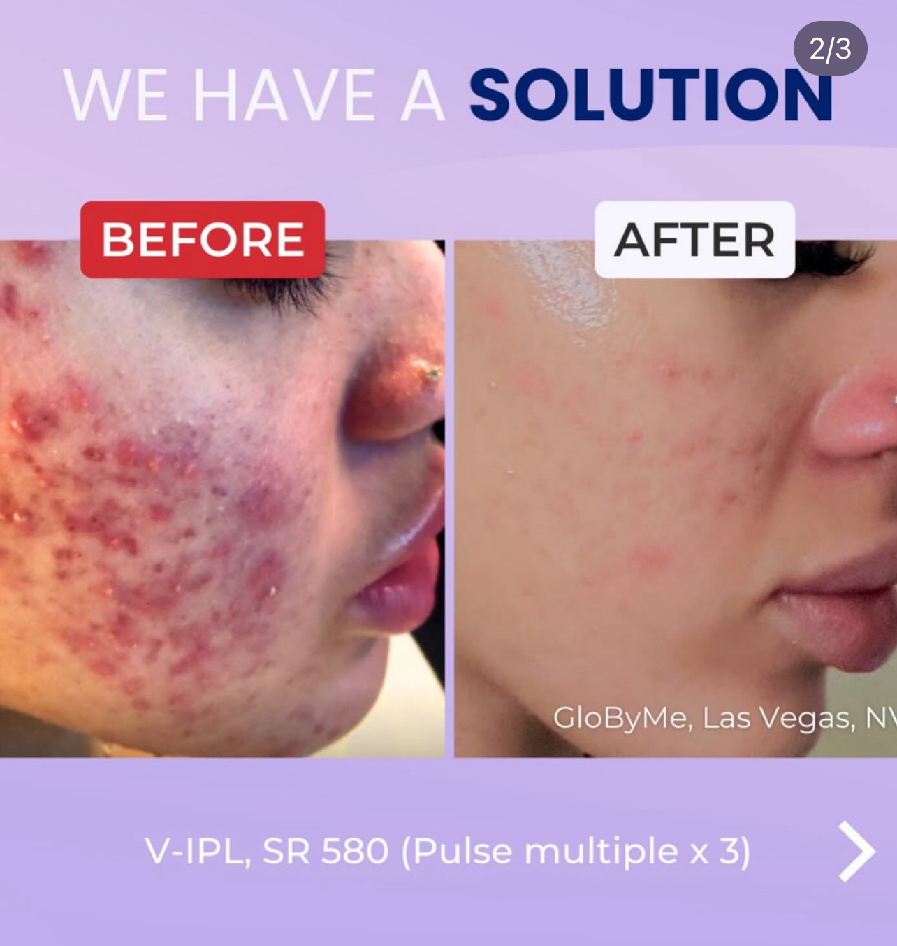 Laser acne treatment (partial) at Magnifique Laser Spa in Rockville Centre, NY