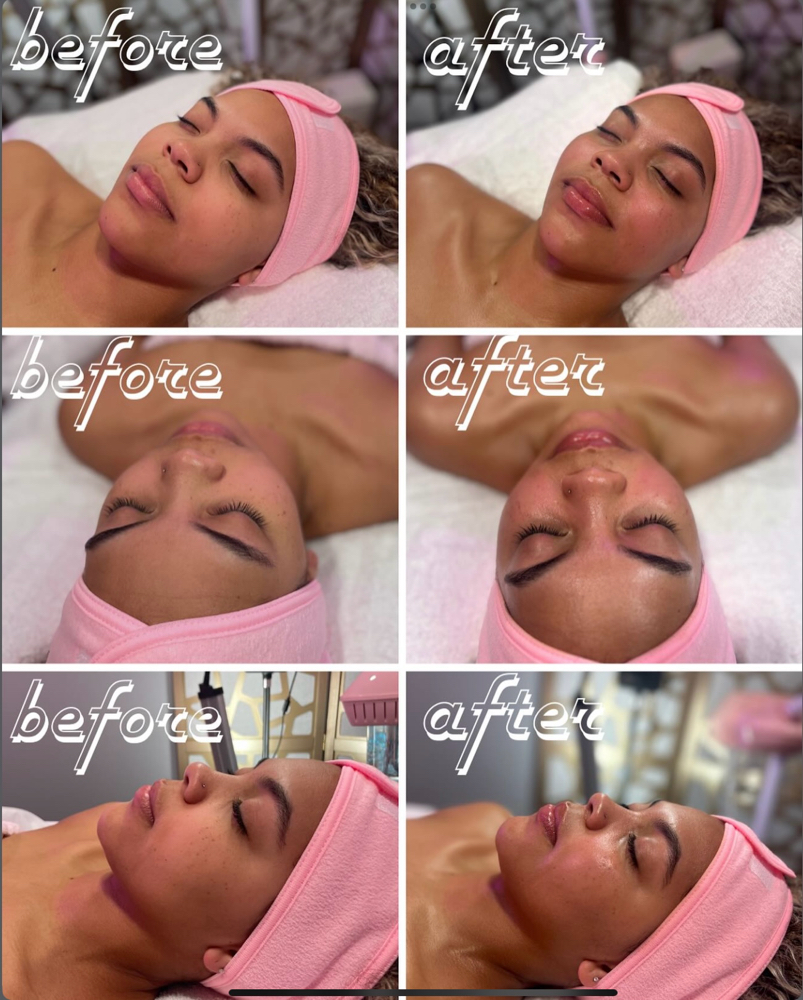 Acne Facial