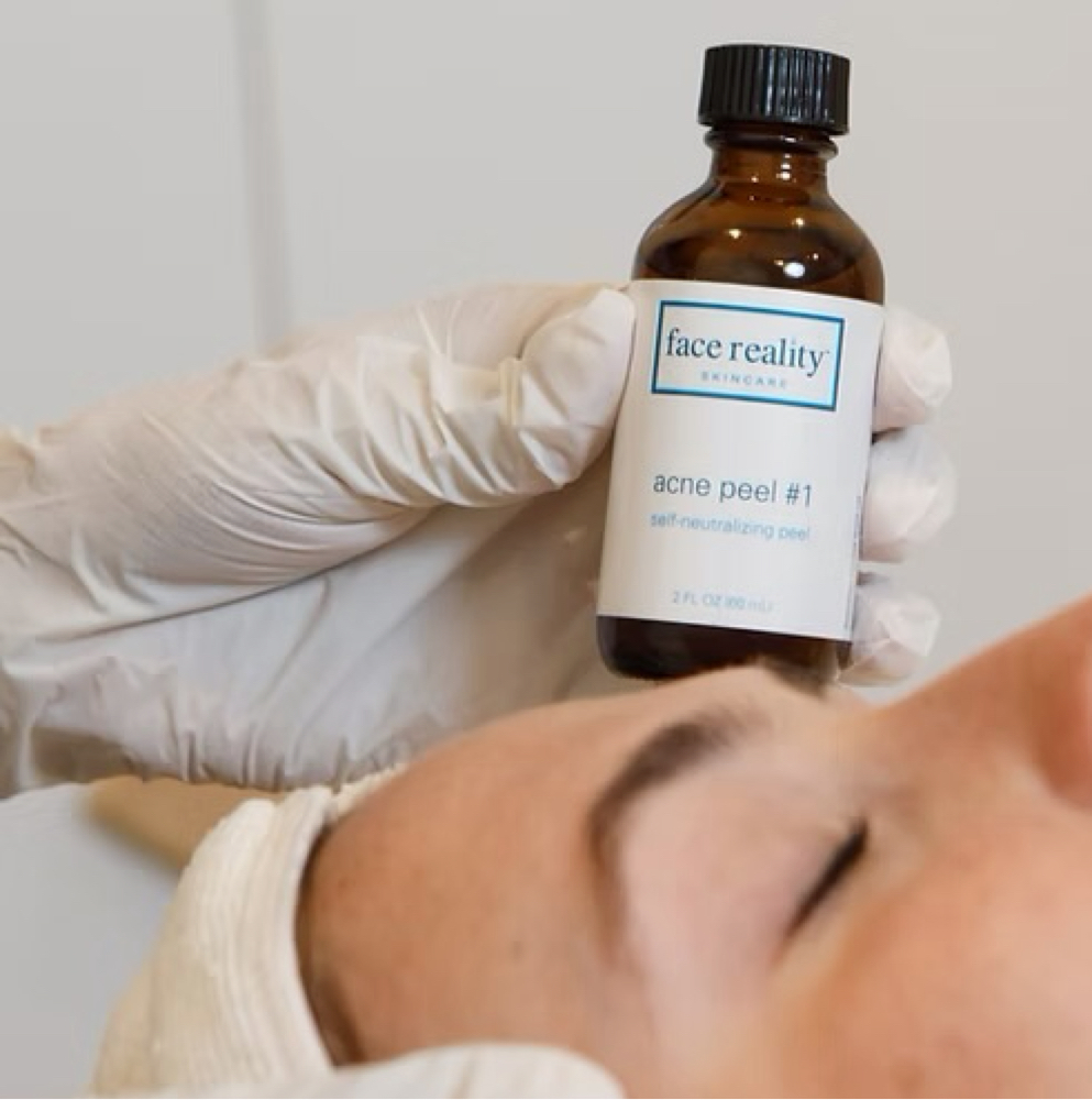 Acne Bootcamp Treatment at Bare Skin Aesthetics in Amityville, NY
