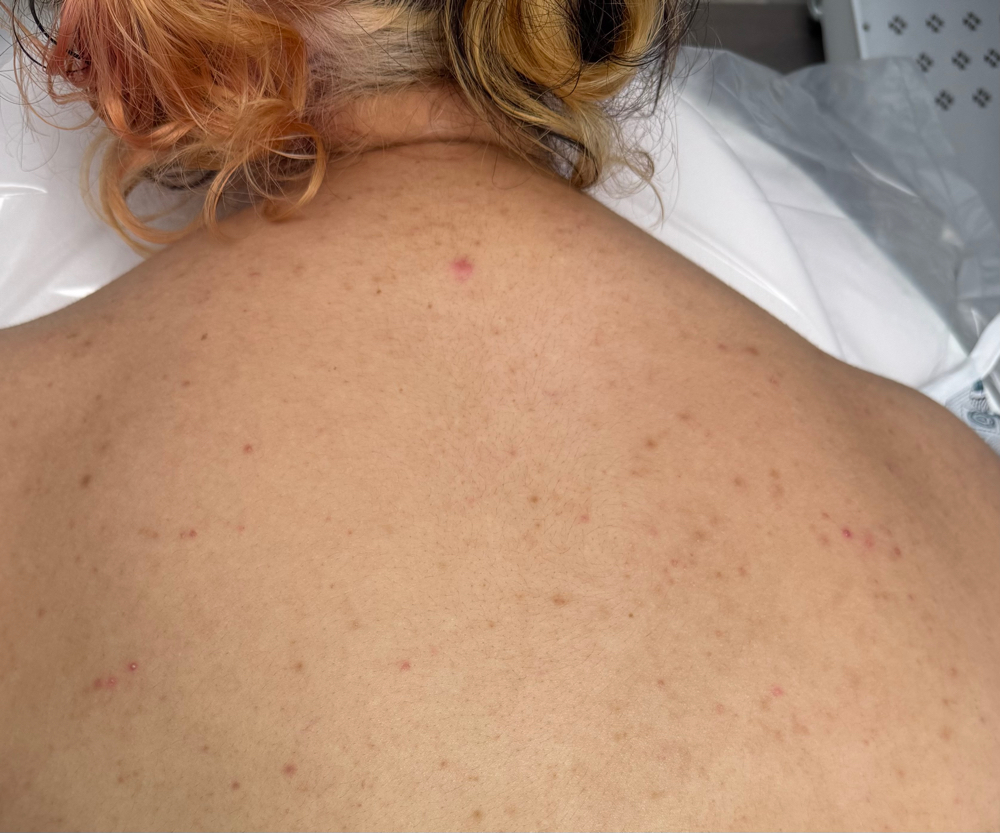 Back Facials