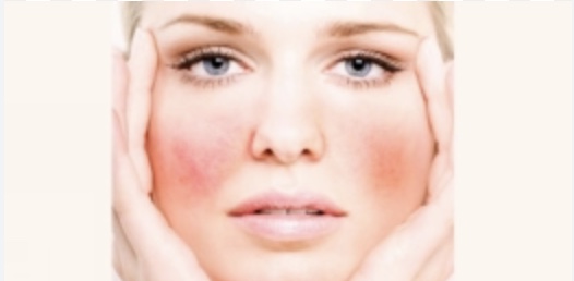 Rosacea Facial