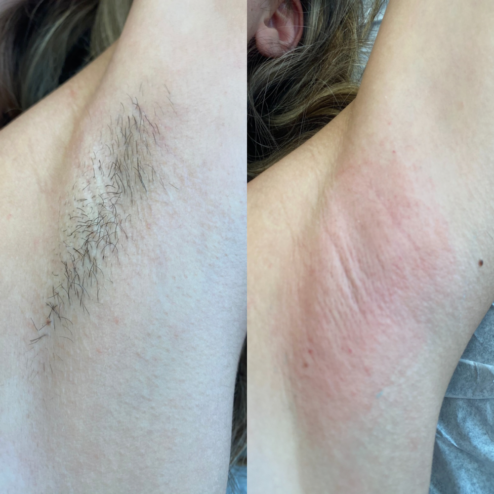 Underarm Wax