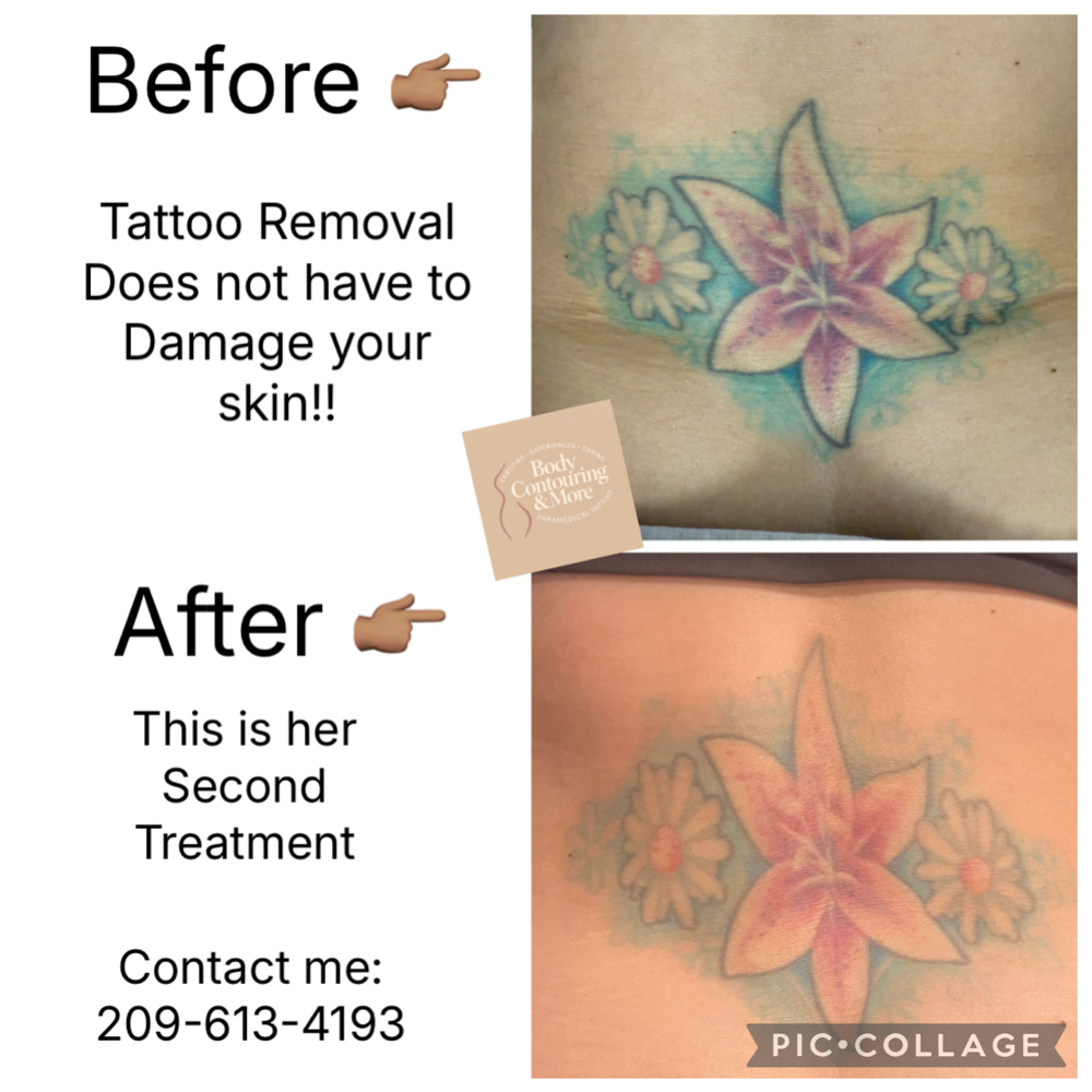 Tattoo Removal (Undo) at Body Contouring & More in Modesto, CA
