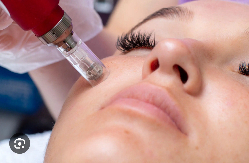 Microneedling Treatment