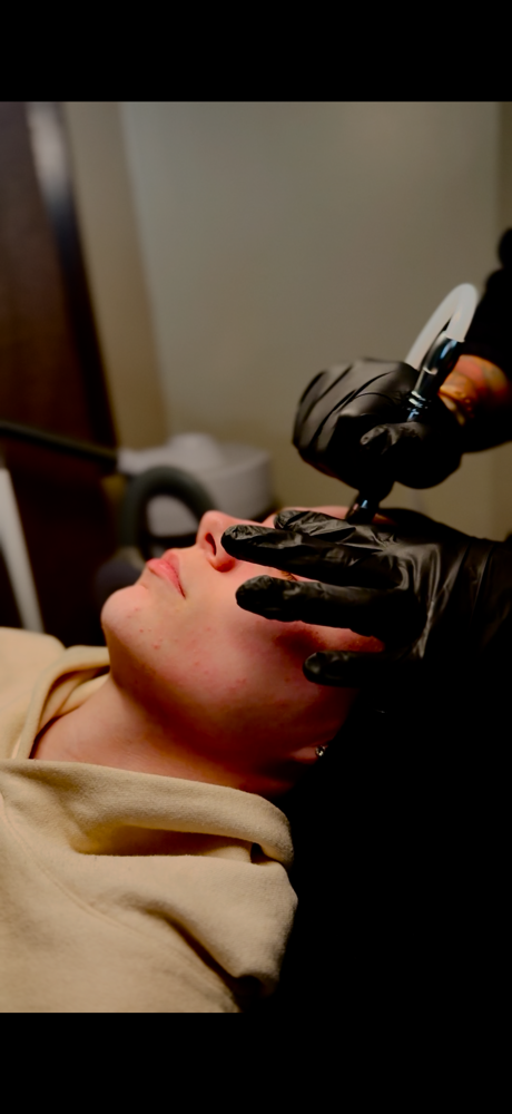 Microdermabrasion Facial