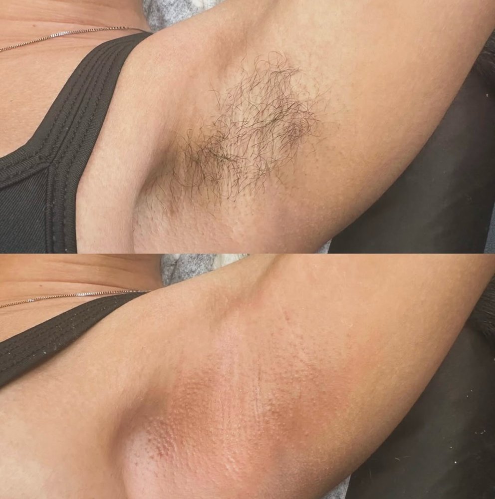 Underarm wax (female anatomy)