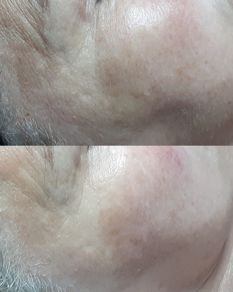 Dermaplaning Facial