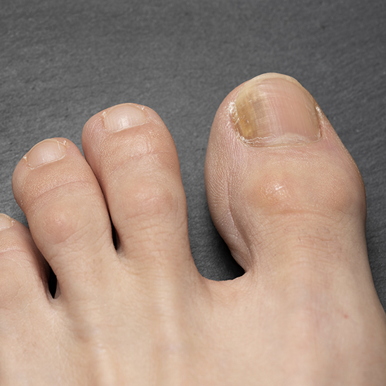 🦶 Toe Fungus Laser Treatment