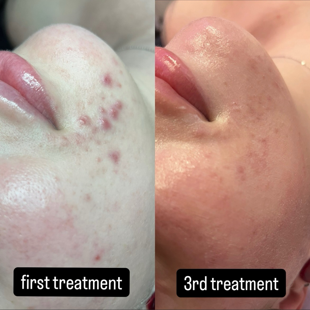 Acne Facial