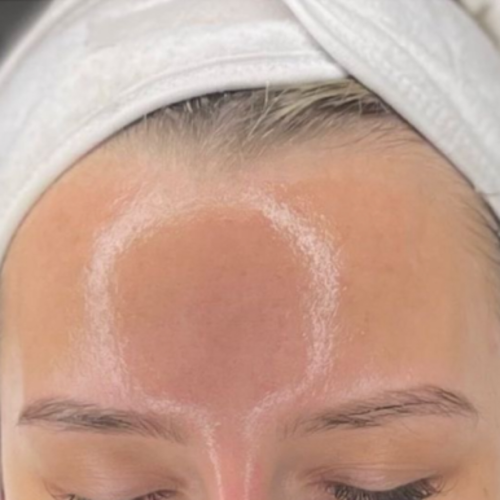 Mesobotox with Peptides at Nenusk Aesthetics in Long Island City, NY