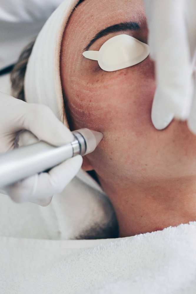 Microdermabrasion Facial