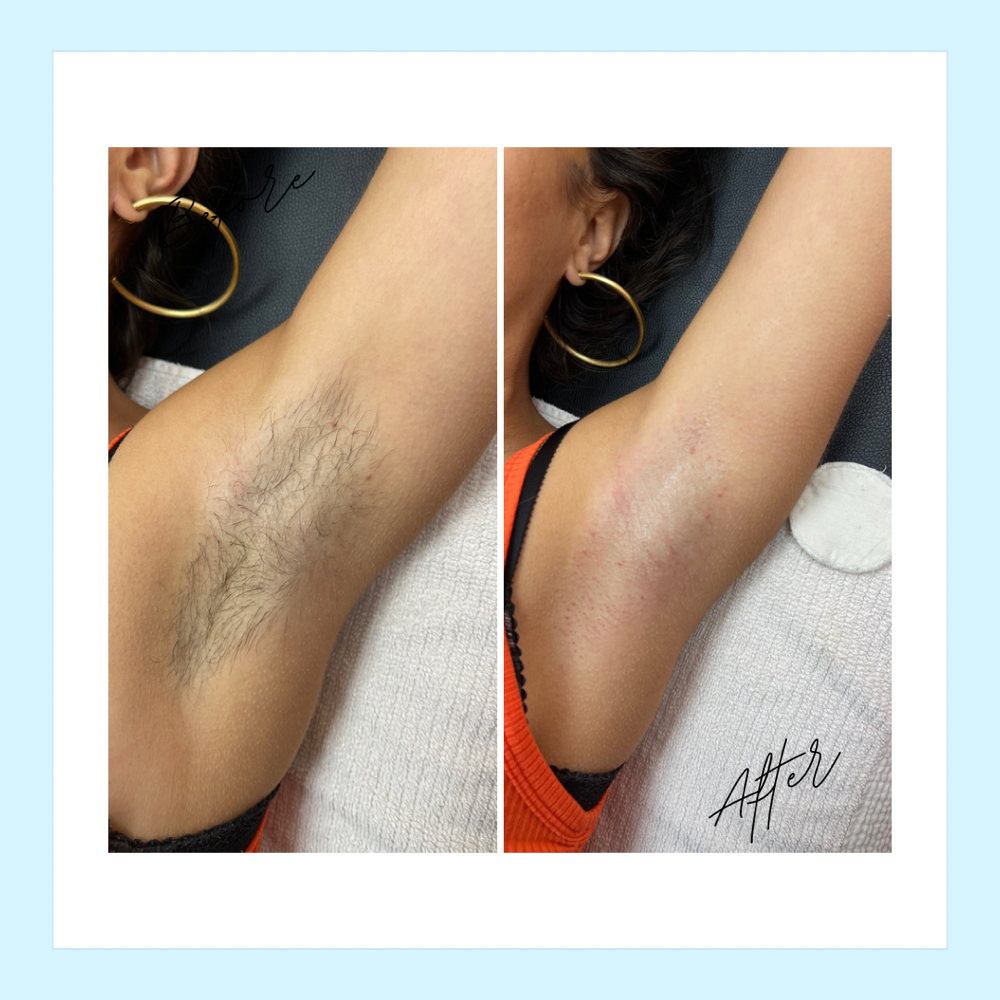 Underarm Sugaring