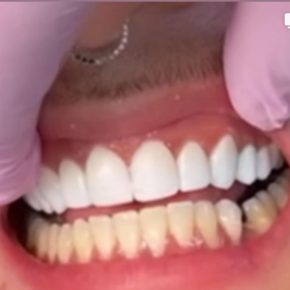 COMPOSITE VENEERS SIMULATION CLASS at GLAM STARR in Roswell, GA